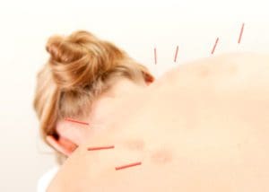 Can Acupuncture Help You Sleep?